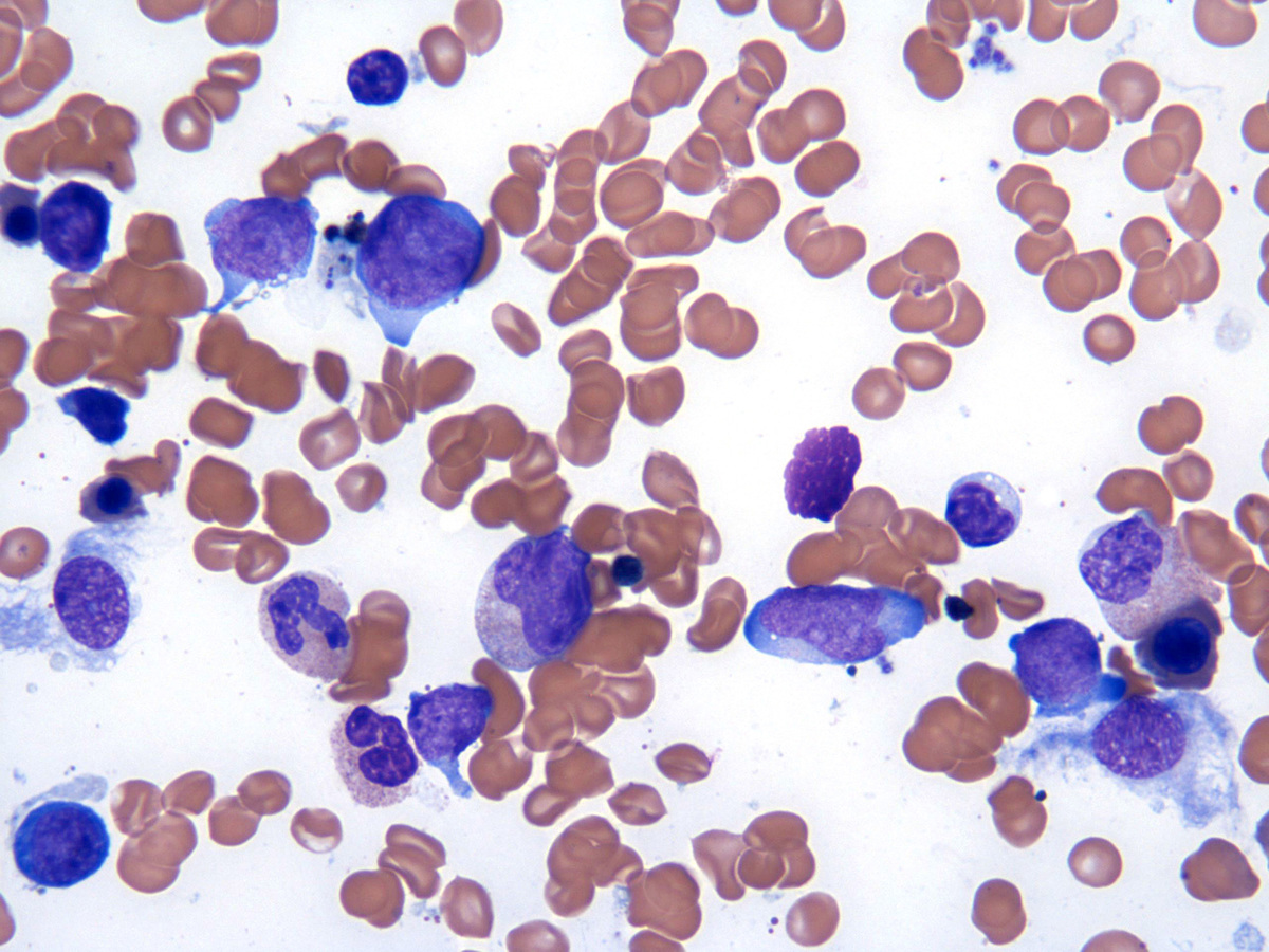 Bone marrow aspirate_4